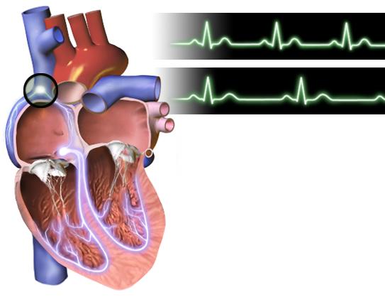 Точка брадикардии в сердце