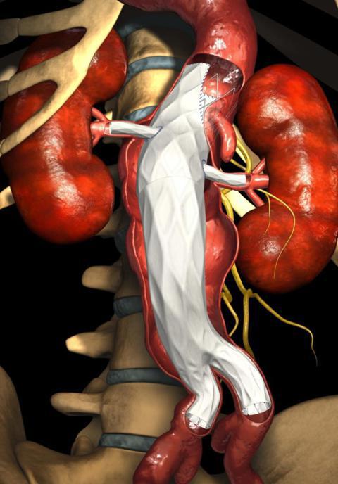 уплотнение аорты сердца 