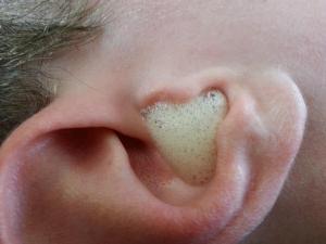 неумывакин лечение перекисью водорода уши
