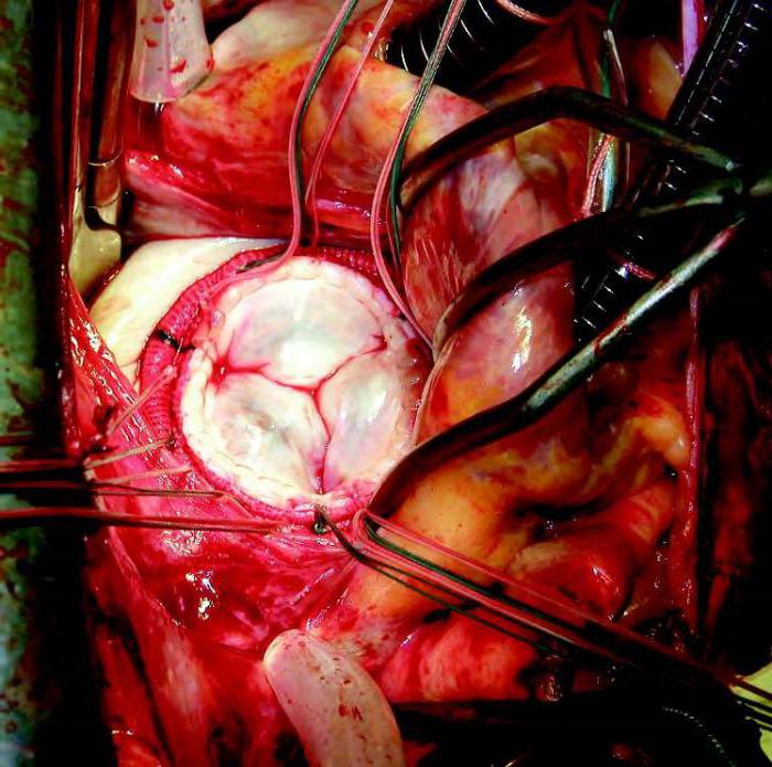 операция по замене аортального клапана