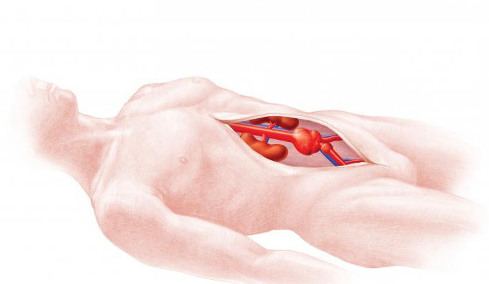 аневризма брюшного отдела аорты