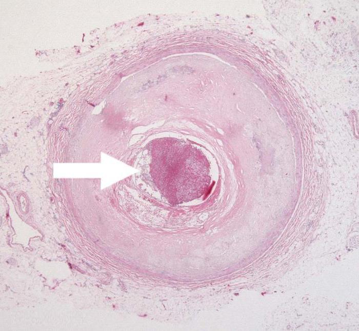 почему образуются тромбы в сосудах лечение