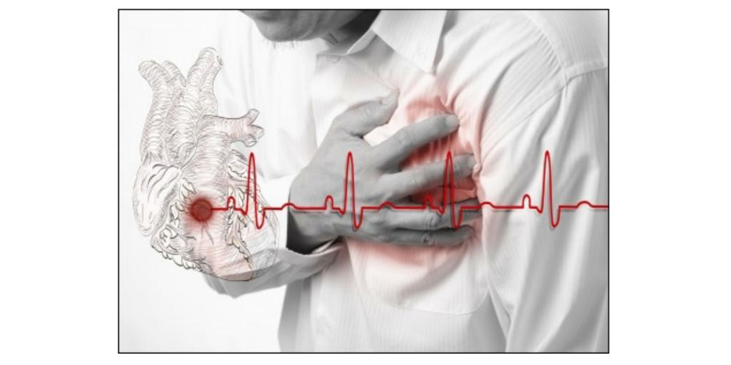 дилатационная кардиомиопатия причины