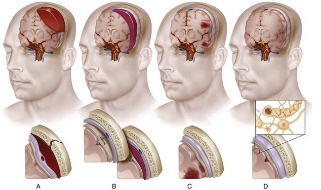 ушиб и сдавление головного мозга 