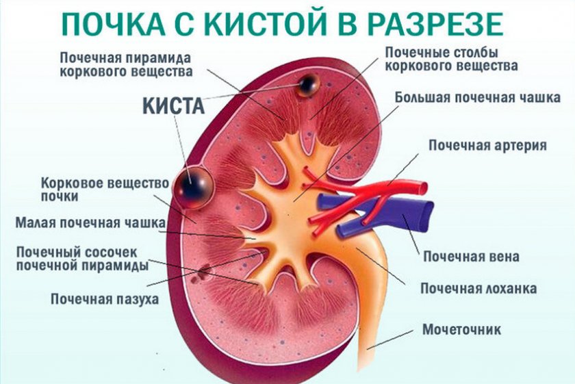 Киста почек