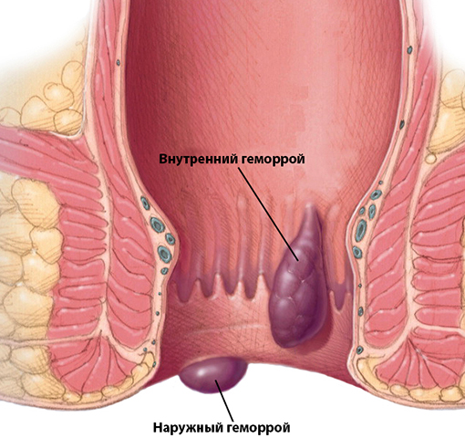 Виды геморроя