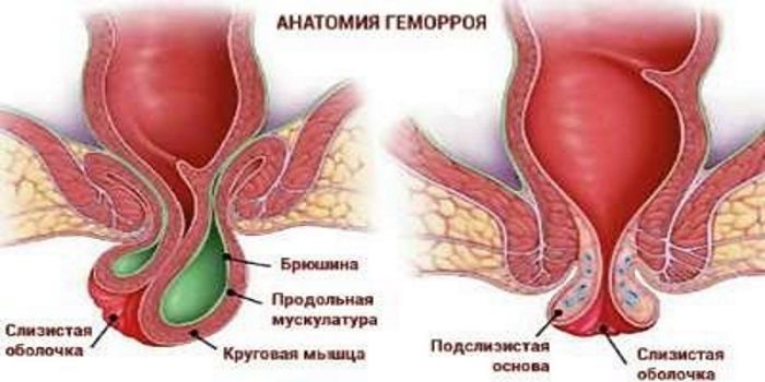 Анатомия геморроя