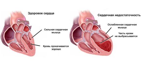 патология сердца