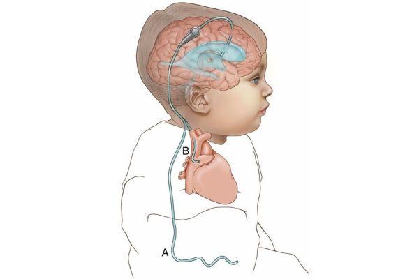 шунтирование мозга ребенка