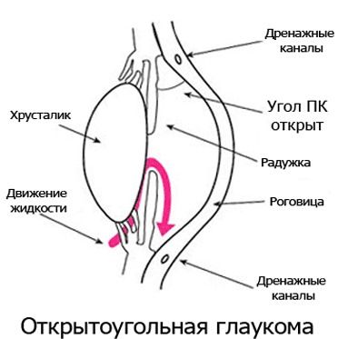 Открытоугольная глаукома