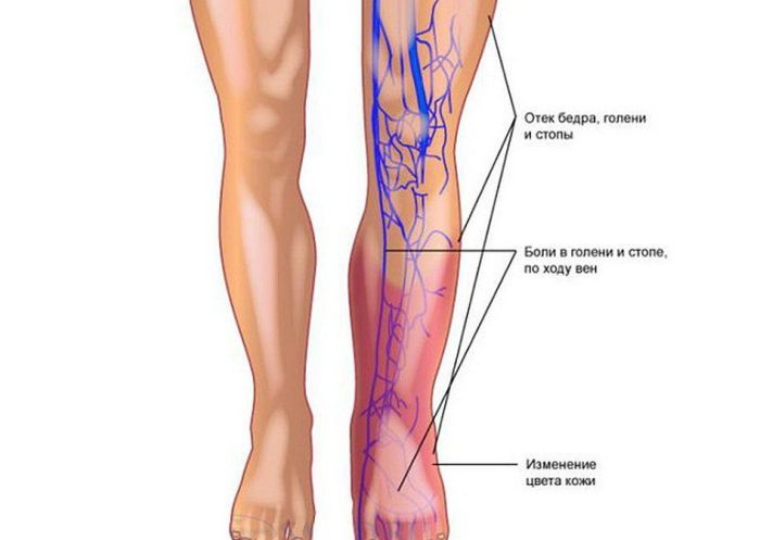 Тромб в ноге