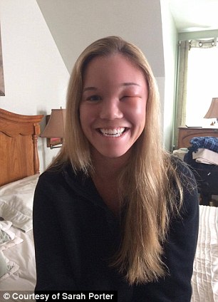 Sarah suffered a very severe and very rare brain infection as a result of her first surgery, making her eye swell up (pictured). It meant she would need another and had to miss her finals