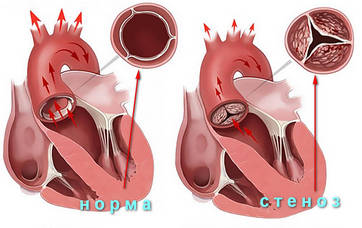 стеноз аортального клапана