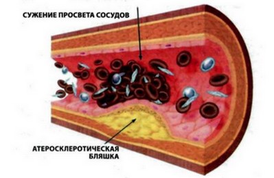 патогенез склероза аорты