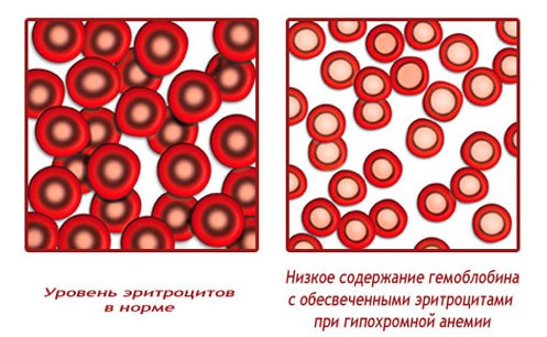 что такое гипохромия