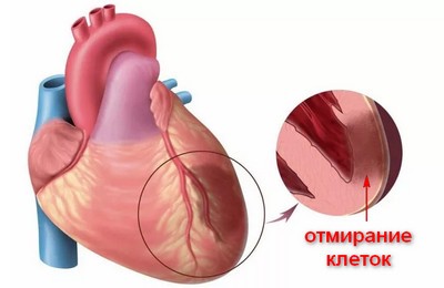 патогенез трансмурального инфаркта