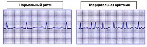 кардиограмма при мерцательной аритмии