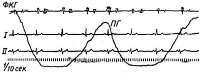 синусовая аритмия на кардиограмме