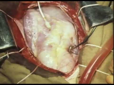 Хирургическое лечение наджелудочковых тахикардий, 1984