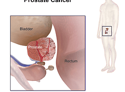 Хирургия простаты: диагноз рака – не приговор