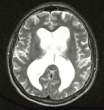МР-томограмма при внутричерепной гипертензии