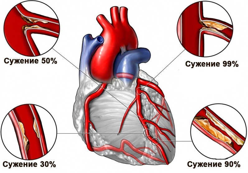 Наглядные признаки закупорки сердечных артерий