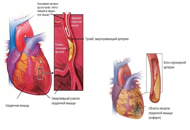 Тромб в сердце: что это такое, симптомы, что делать, лечение