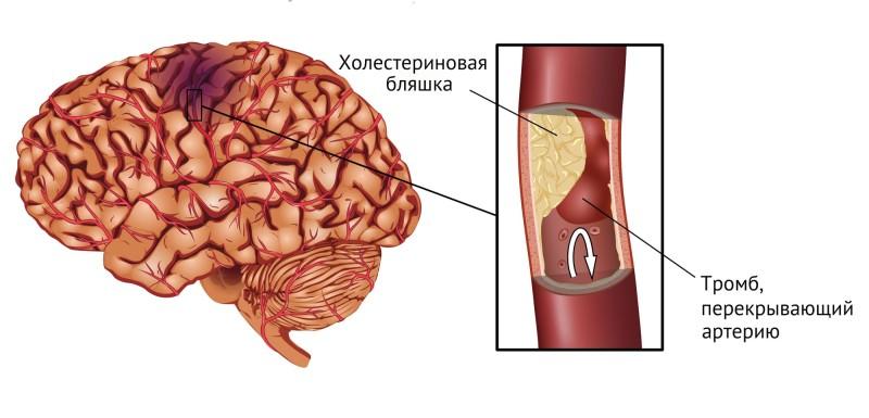 Ишемический инсульт