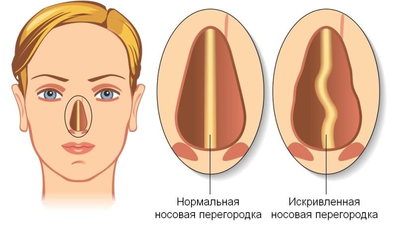 Искривление перегородки носа