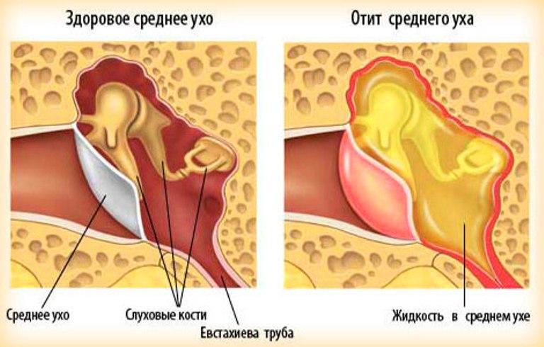 Отит среднего уха