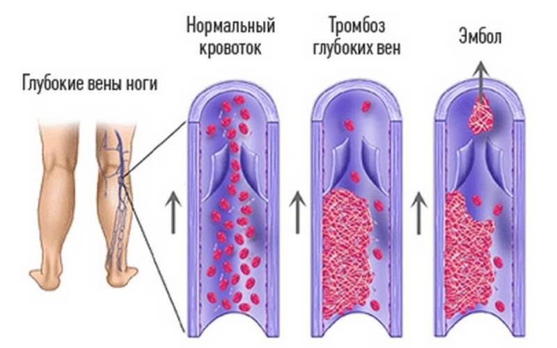 Венозный тромбоз