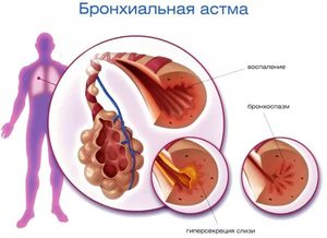 Что такое бронхиальная астма