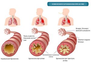 Какие изменения в бронхах при астме