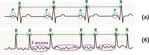 Как выглядит мерцательная аритмия на ЭКГ