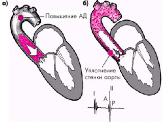 Схема уплотненной аорты
