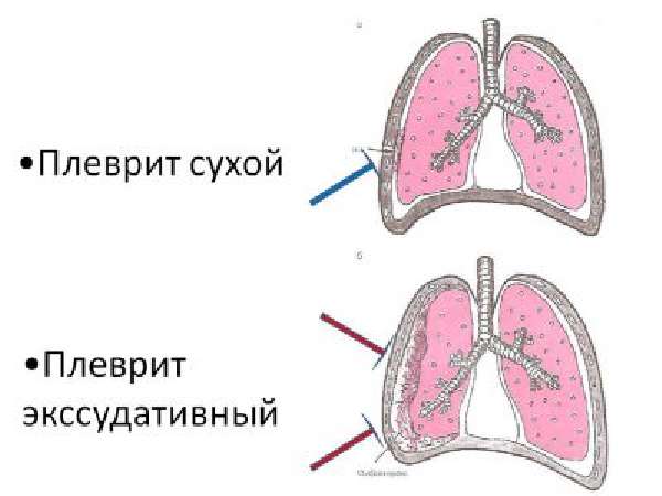 Заболевания дыхательных органов