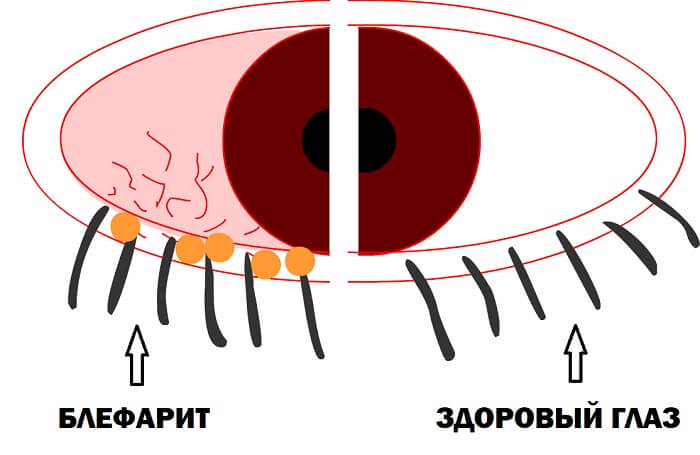 Развитие блефарита глаза