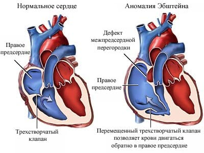 Аномалия Эбштейна