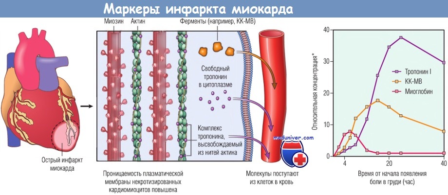 Маркеры инфаркта миокарда