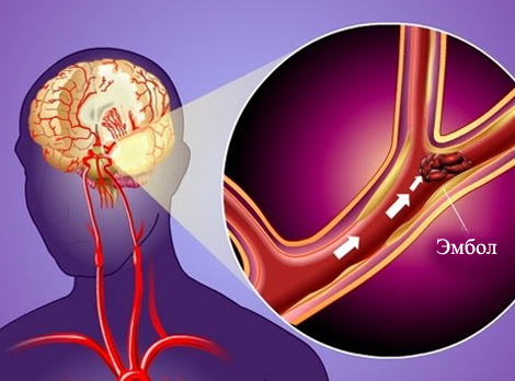 Эмбол в крови