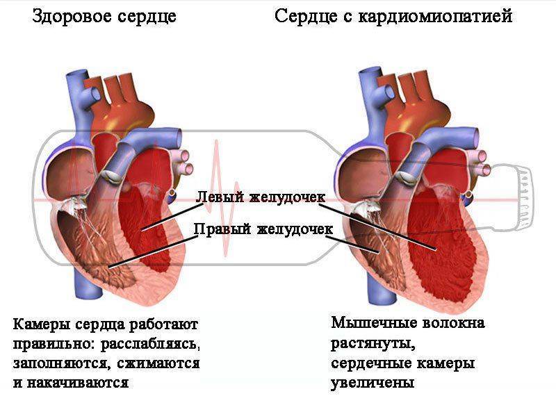 Норма и кардиомиопатия