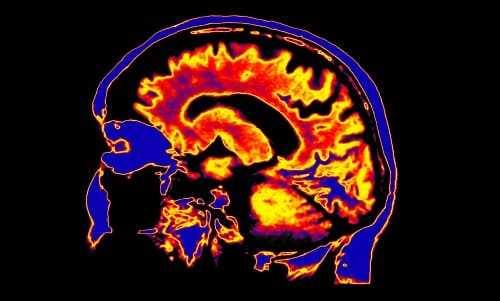 Изображение мозга не МРТ с контрастированием