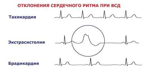 Патология кардиограммы при ВСД