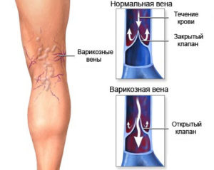 Варикоз - первый симптом отечности ног