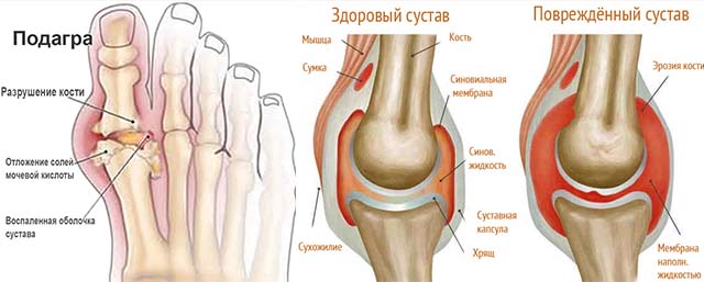 Подагра большого пальца и коленного сустава