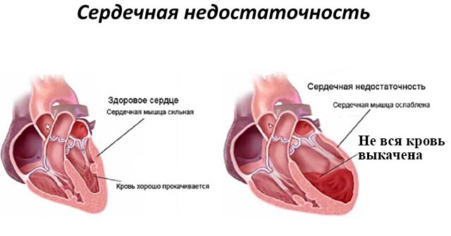 Заболевания сердечно-сосудистой системы