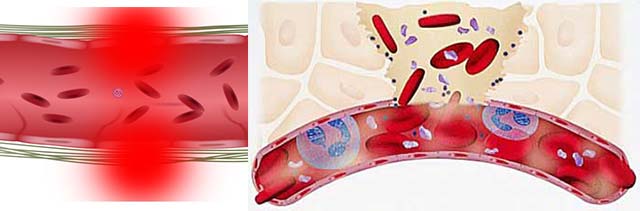 Повреждение стенок сосудов