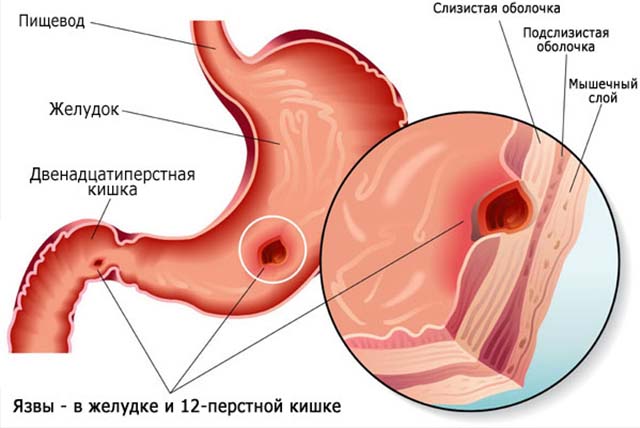 Язва 12-перстной кишки