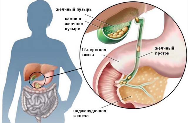 Желчные камни в протоке