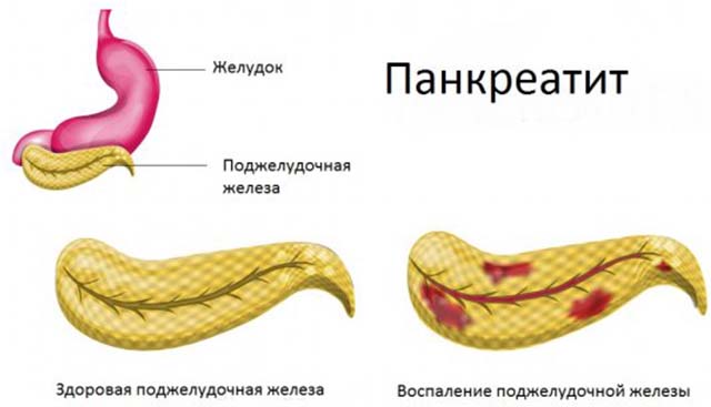 Панкреатит